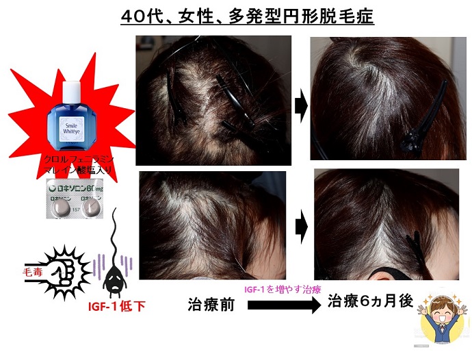 円形脱毛症　病院